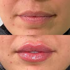 Labial efecto ácido hialuronico